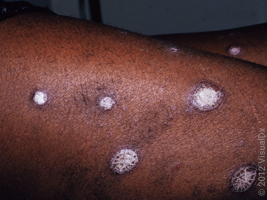 Here’s What Psoriasis Looks Like Around the Body (With Pictures) - GoodRx