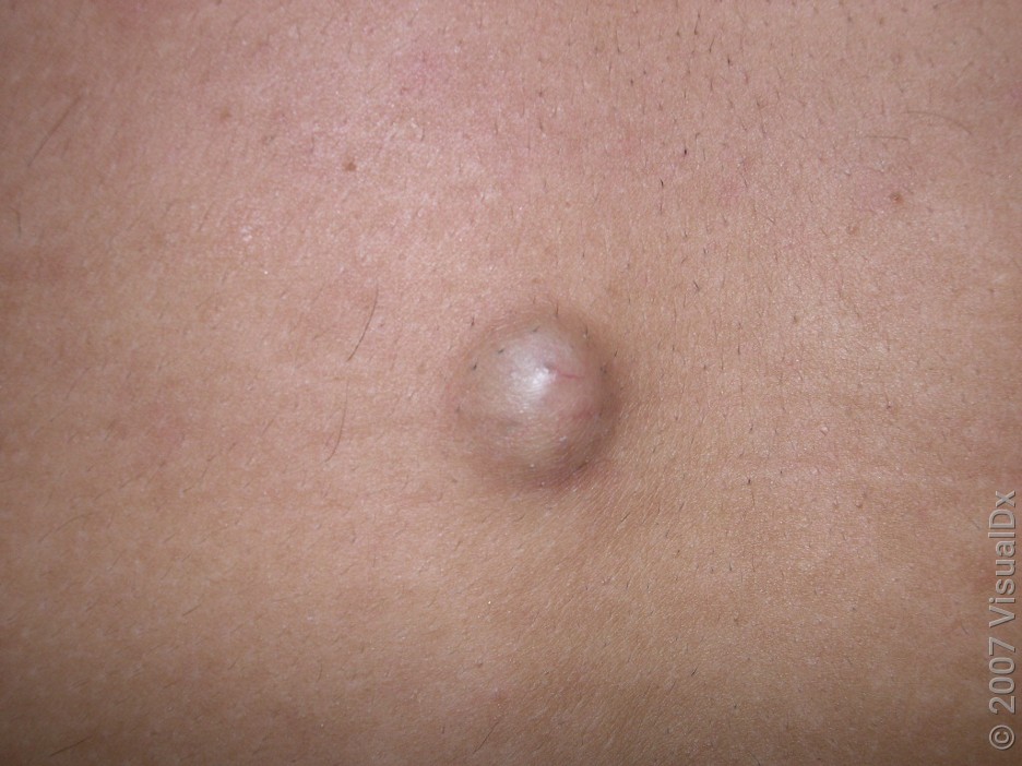 Close-up of a sebaceous cyst on the back. 