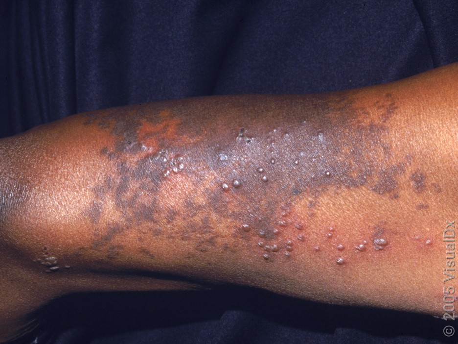 What to Expect With Shingles Rash: Early Stages and Progression - GoodRx