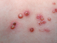 Mollusken Contagiosa Molluscum Contagiosum
