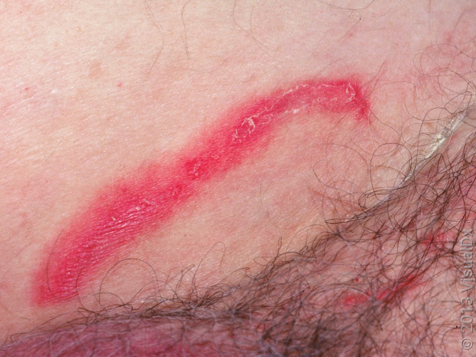 Ringworm in the groin (jock itch or tinea cruris).