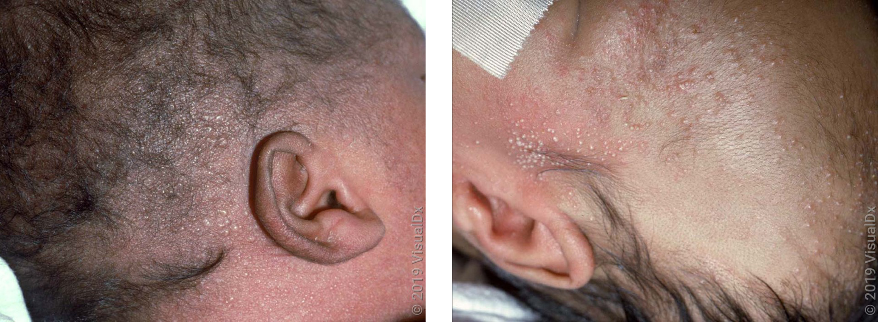 Left: Small, clear blisters on the neck and scalp of an infant with miliaria. Right: Many white and red pus bumps on the face and scalp in an infant with miliaria.