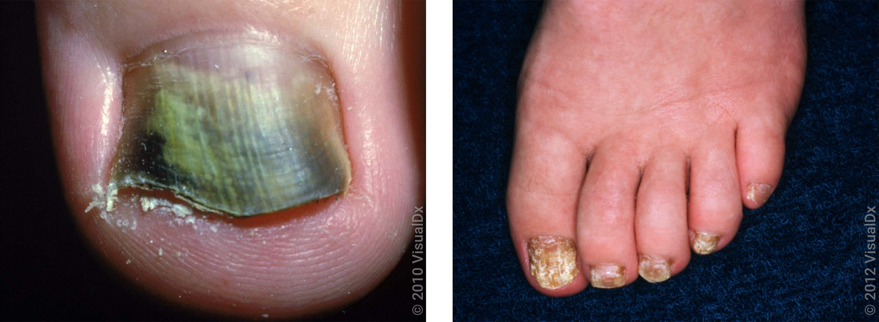 How Contagious Is Nail Fungus?: Warrenton Dermatology & Skin Therapy  Center: Board-Certified Dermatologists