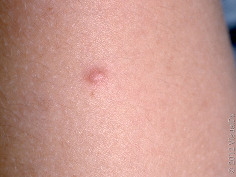 A close-up look at a dermatofibroma on fairer skin.
