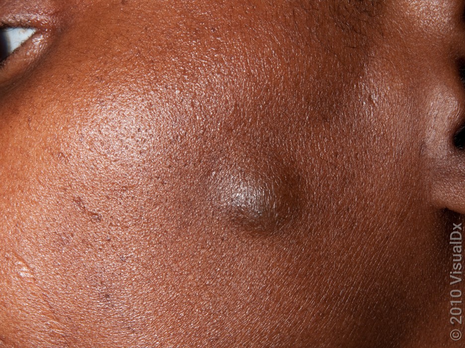 Close-up of a sebaceous cyst on the face. 
