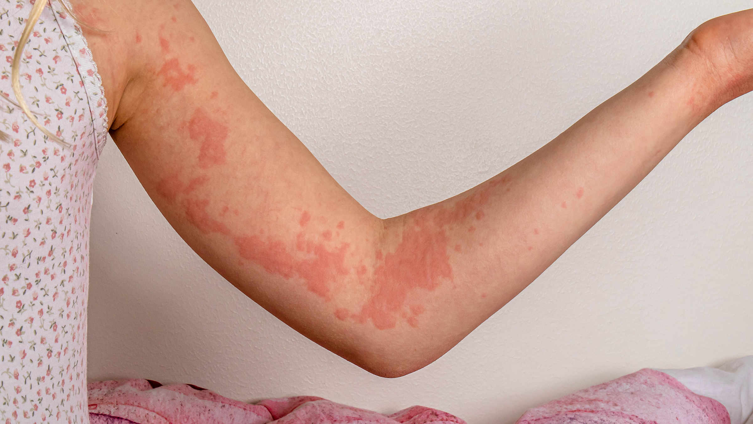 what to do for hives