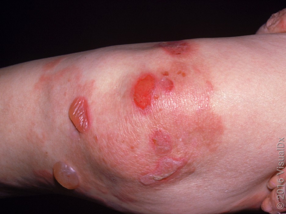 A close-up look at blisters and open sores on the leg from bullous pemphigoid. 