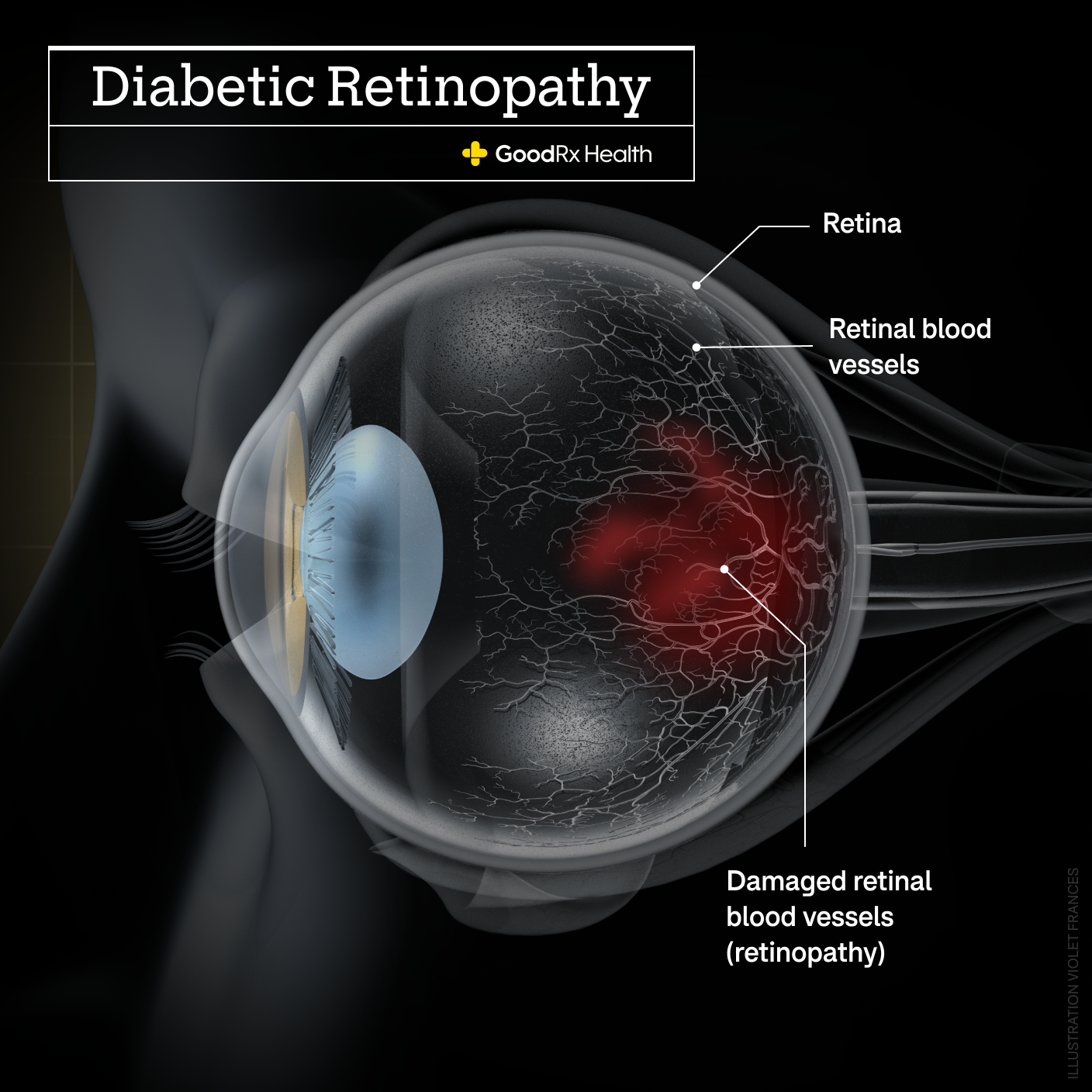 A 3D illustration of diabetic retinopathy highlighting the retina, normal retinal blood vessels, and damaged retinal blood vessels. 