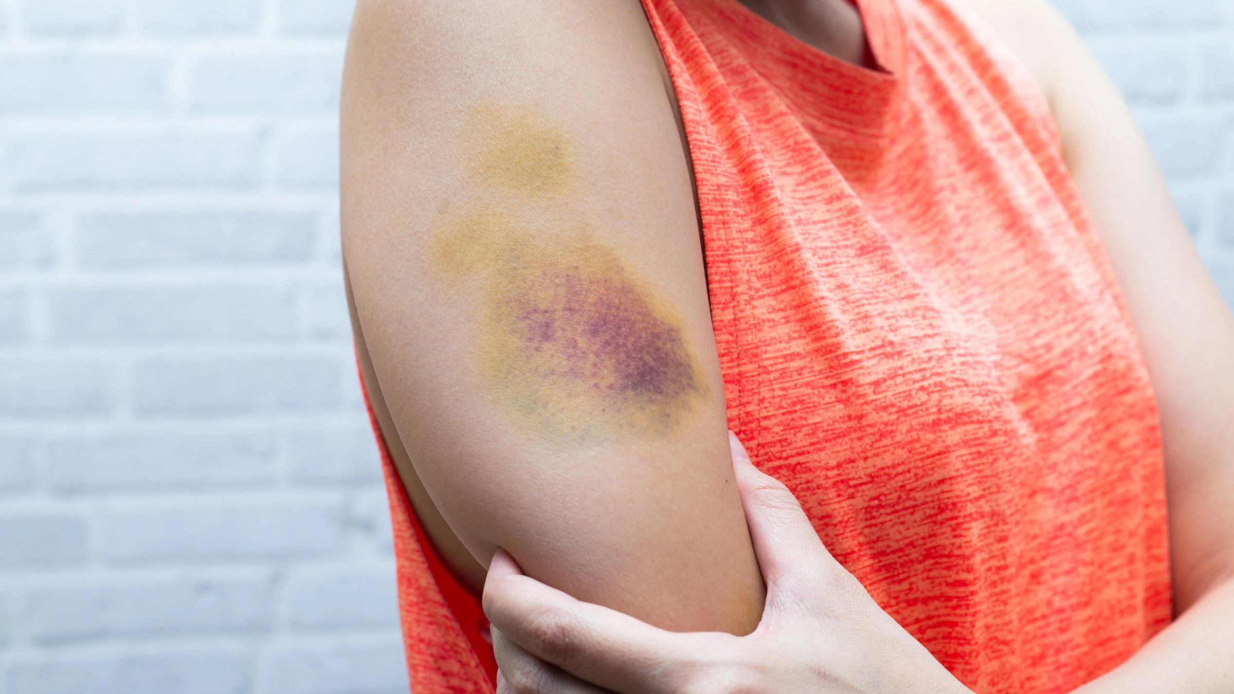 Why Do Bruises Itch?
