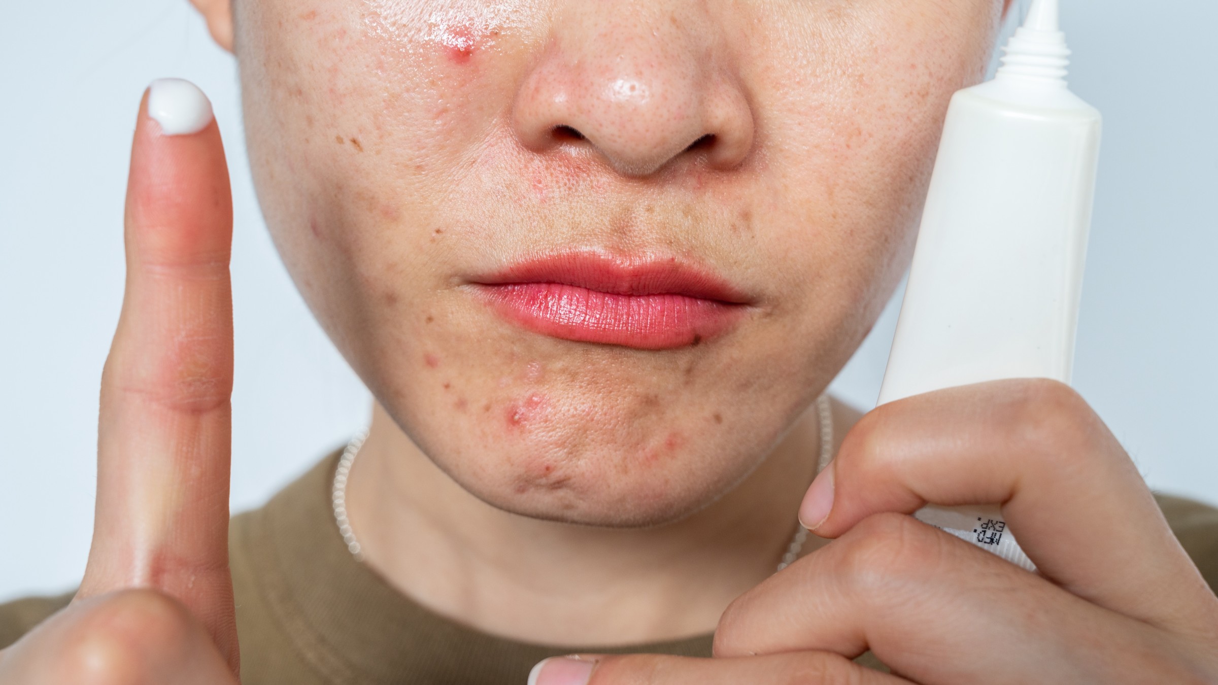 accutane side effects babies