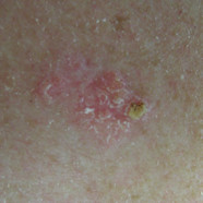 Squamous Cell Carcinoma Early Stages Early Skin Cancer Pictures And Squamous Cell Carcinoma Early Stages Early Skin Cancer Pictures And