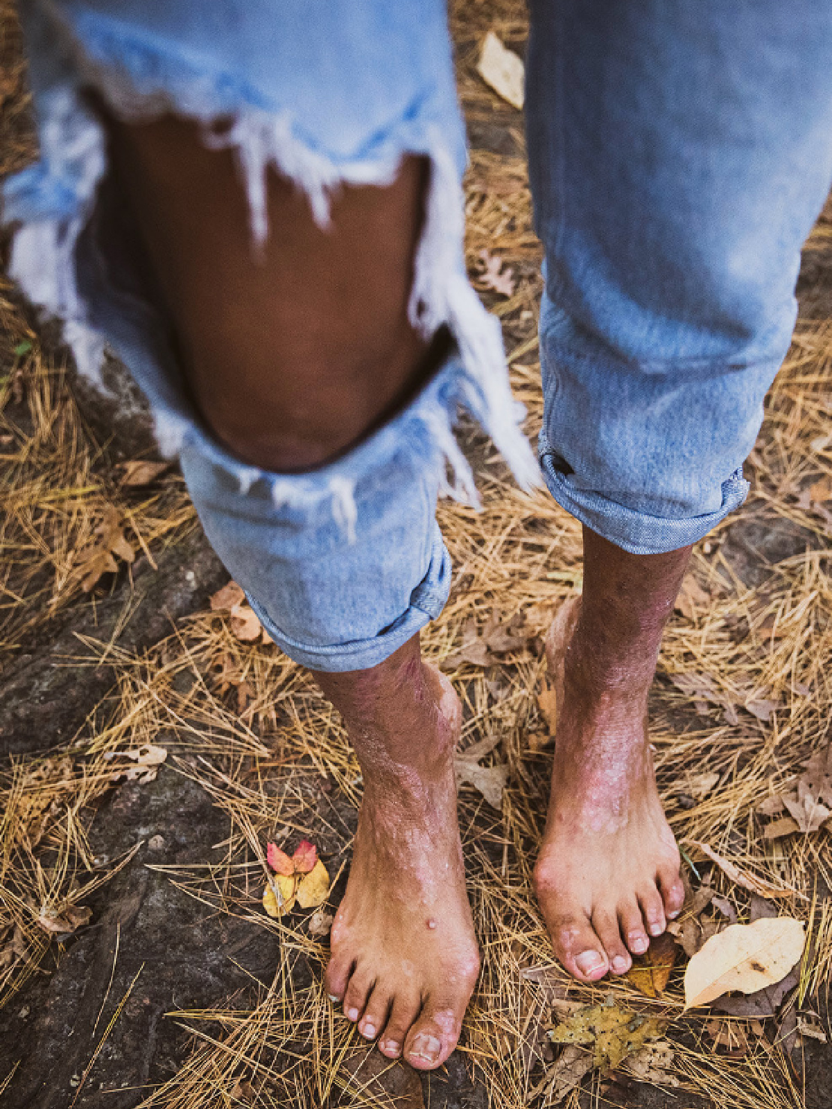Reena shows psoriasis on her ankles and feet.