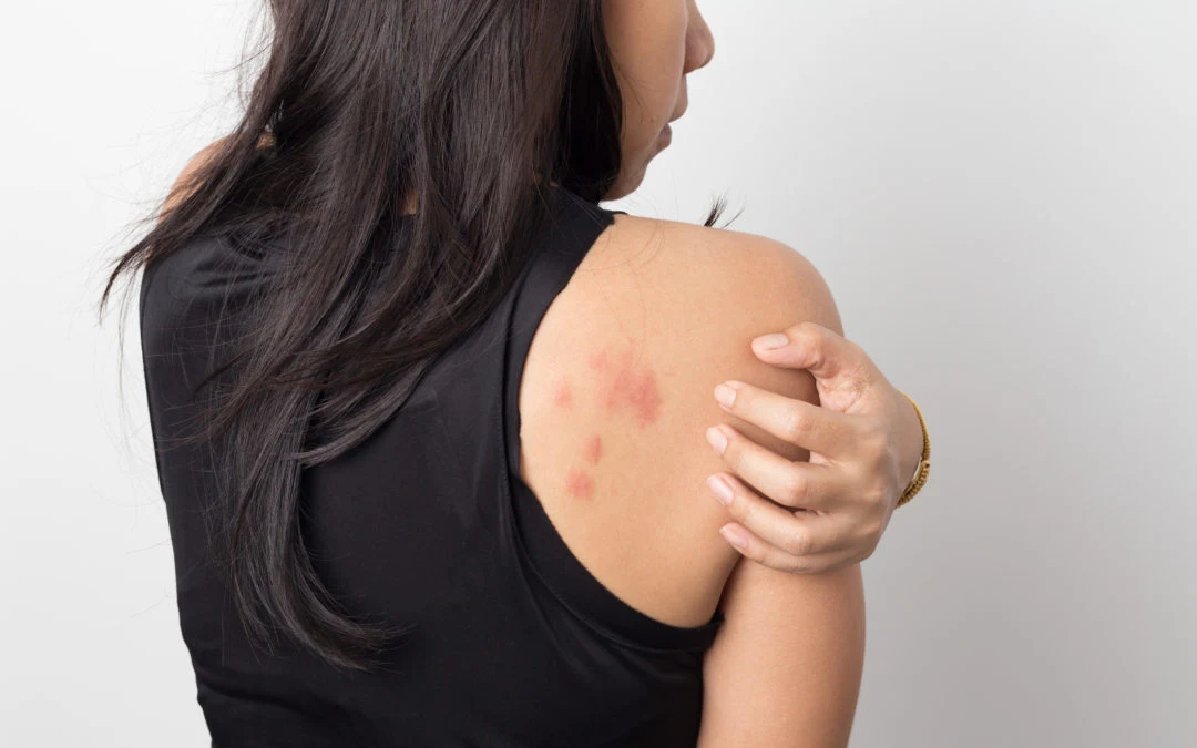 What You Need to Know About Eczema