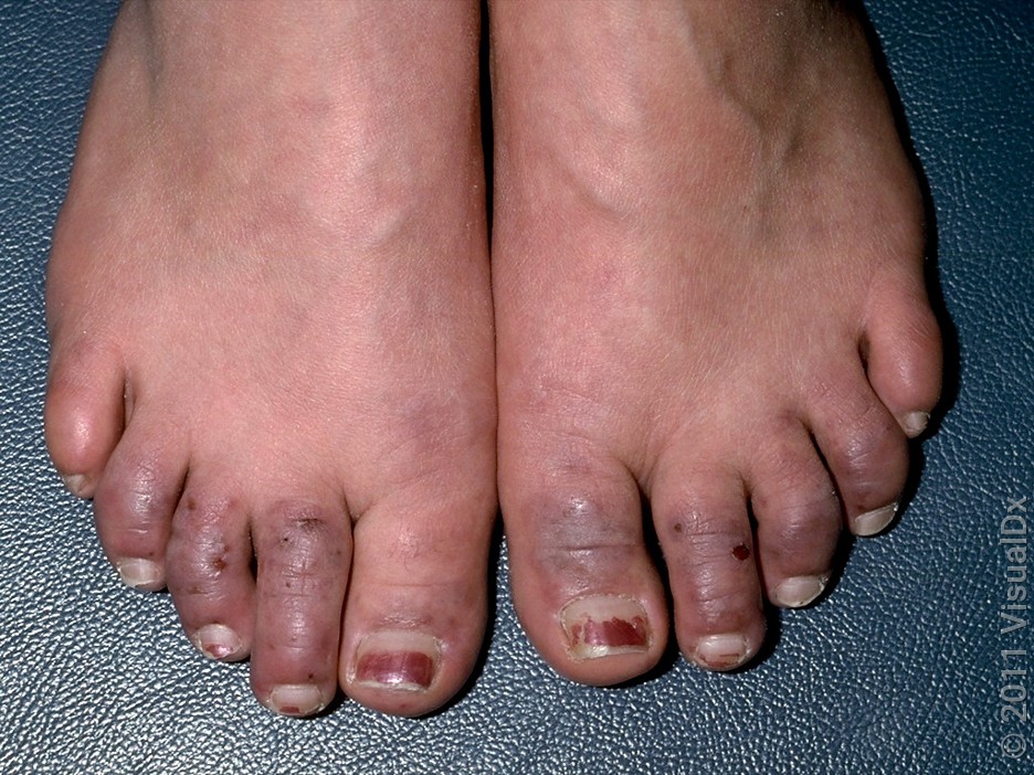 Close-up of Raynaud’s syndrome on the feet. 