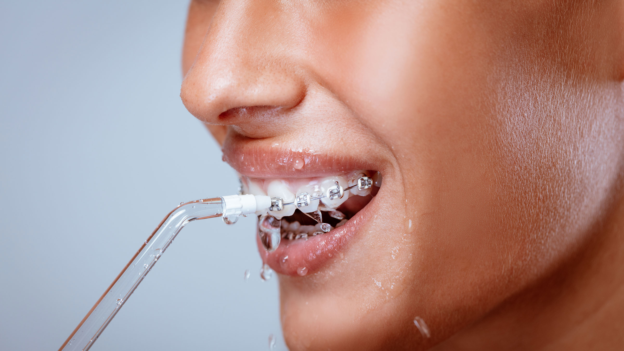 Cost of Braces: Breaking Down the Cost of 3 Kinds of Popular Braces - GoodRx