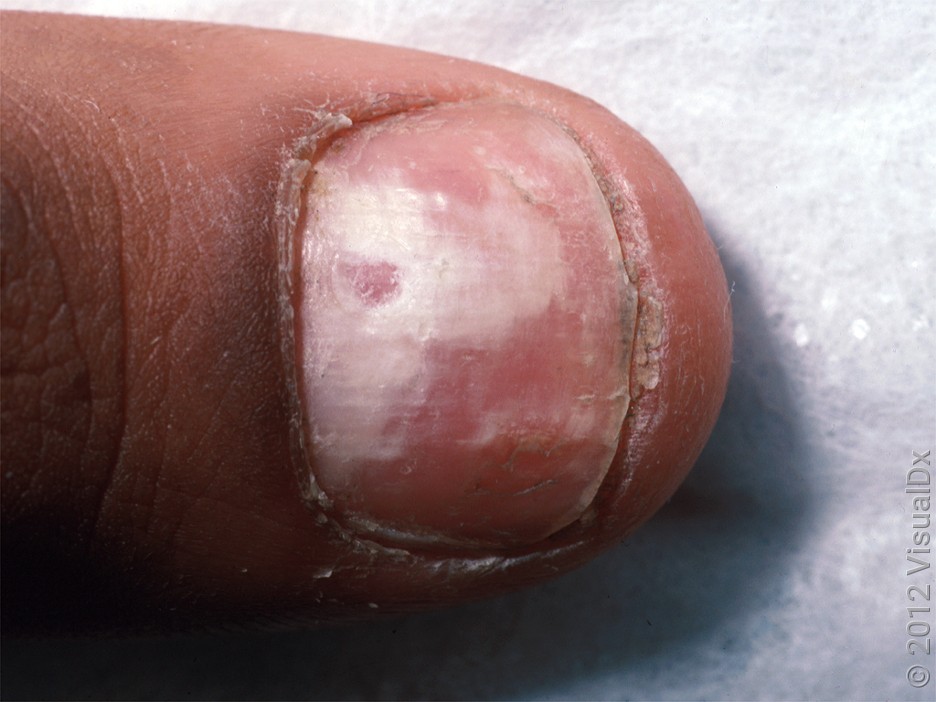 Onychomycosis (Nail Fungus) | Juniper Dermatology