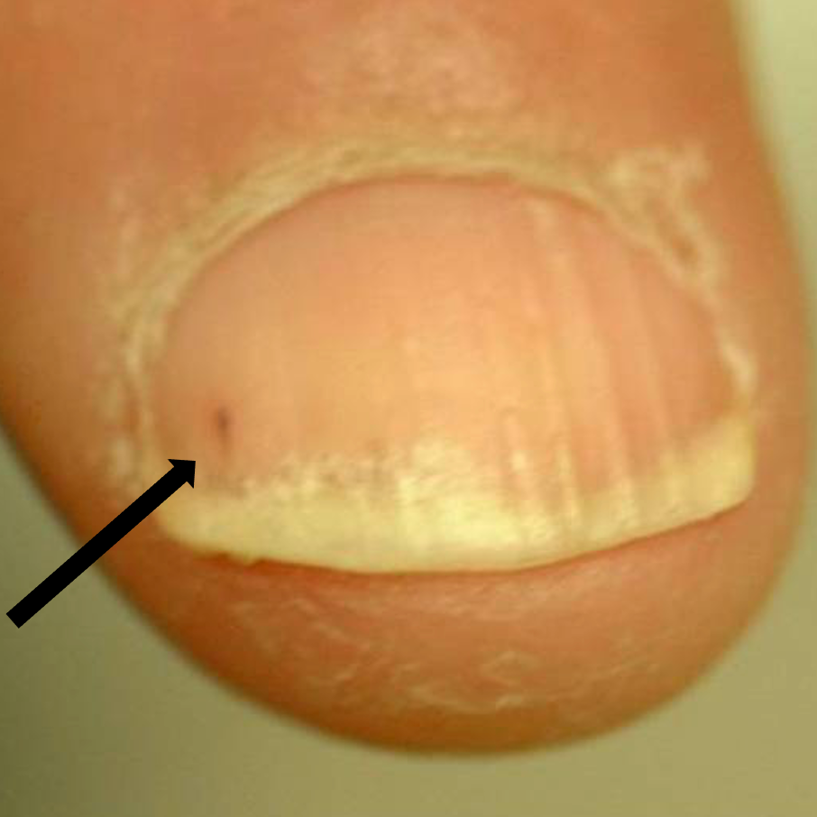 Understanding Nail Psoriasis | Arlington Dermatology