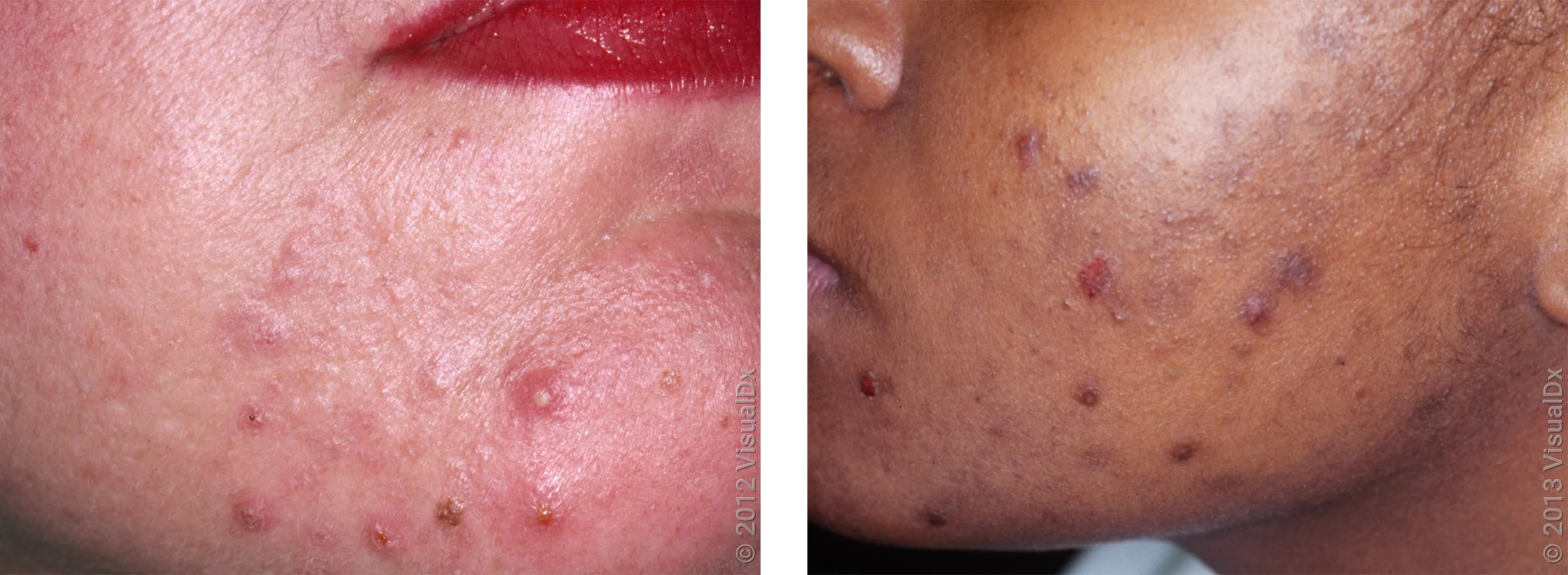 Left: Several red and white skin bumps (pimples) on the chin. Right: Many brown skin bumps and marks on the cheek with a few small sores. 