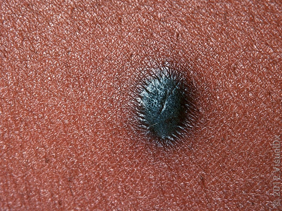 Dark dermatofibroma on a darker skin tone.