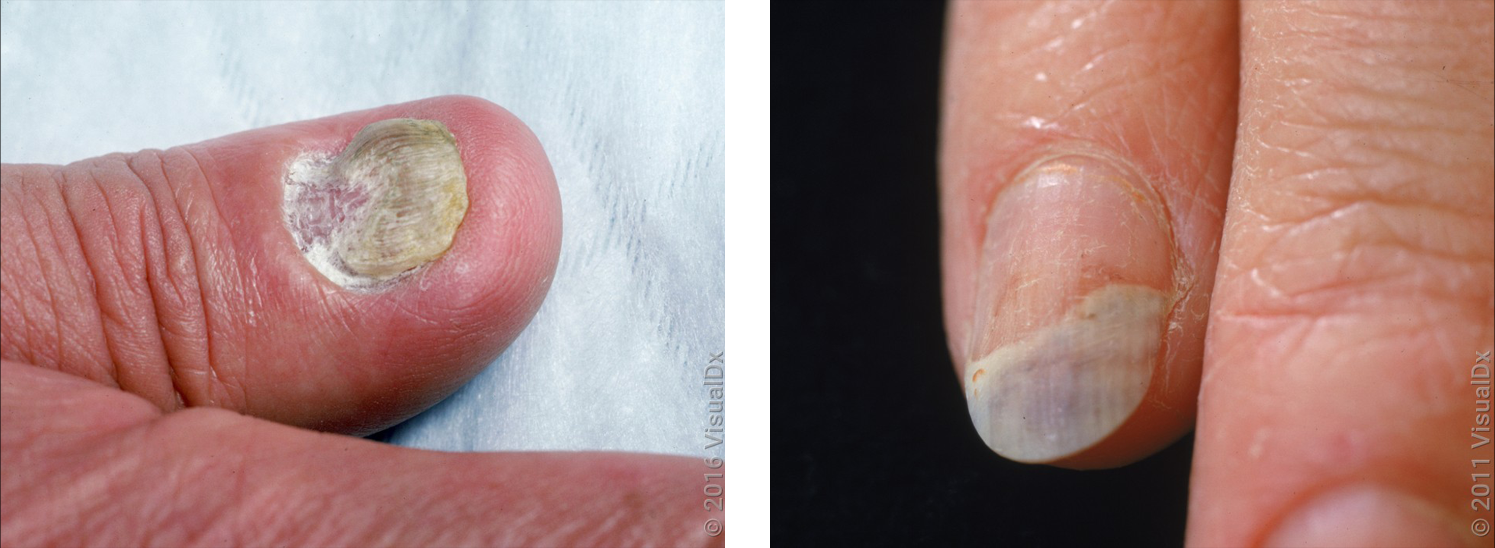 What Is Onychomycosis (Nail Fungus), and What Does It Look Like? - GoodRx