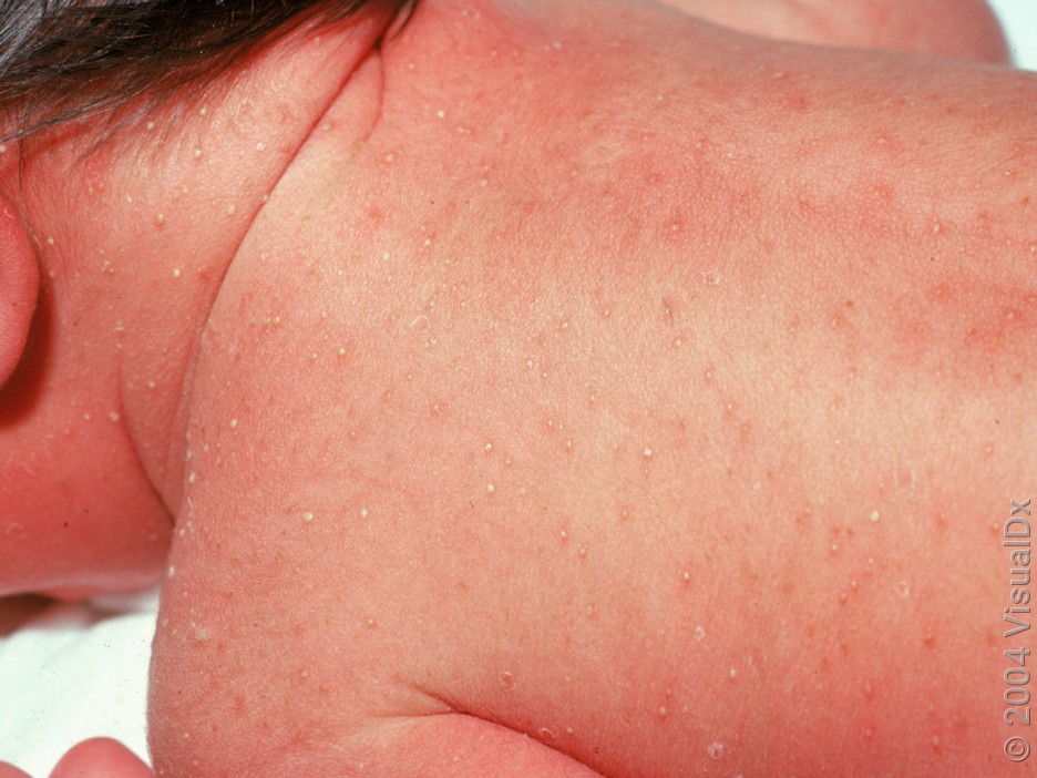 Many tiny, white pus bumps and dark patches on the neck and back of an infant.