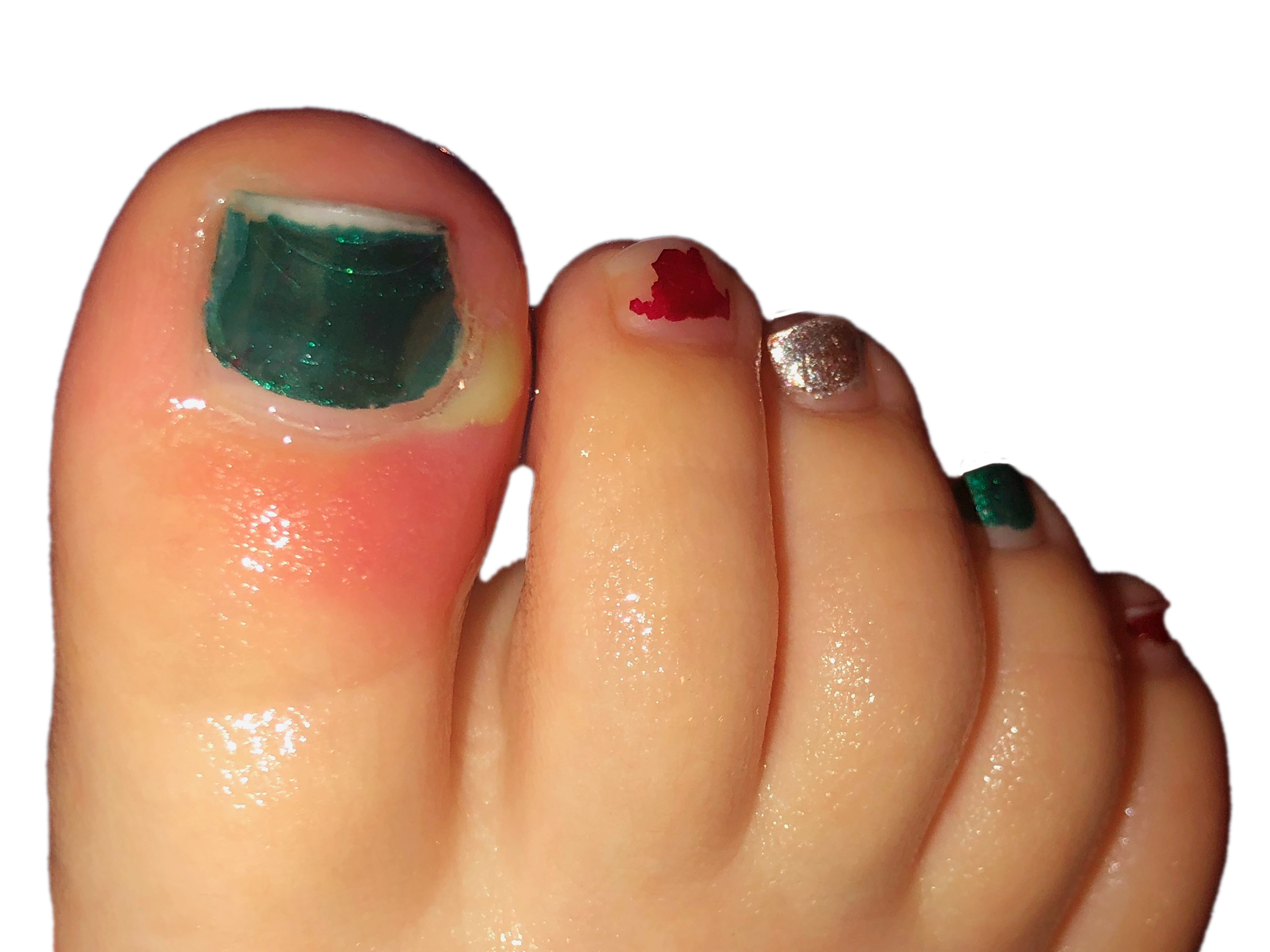 What you need to know about pseudomonas nail infections aka 