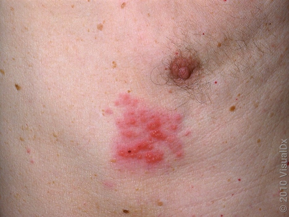 The Connection Between COVID-19 and Shingles (With Images) - GoodRx