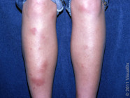 Erythema Nodosum Pictures And Symptoms To Look Out For