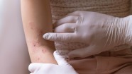 11 Common Rashes On Kids And Preschoolers With Images GoodRx