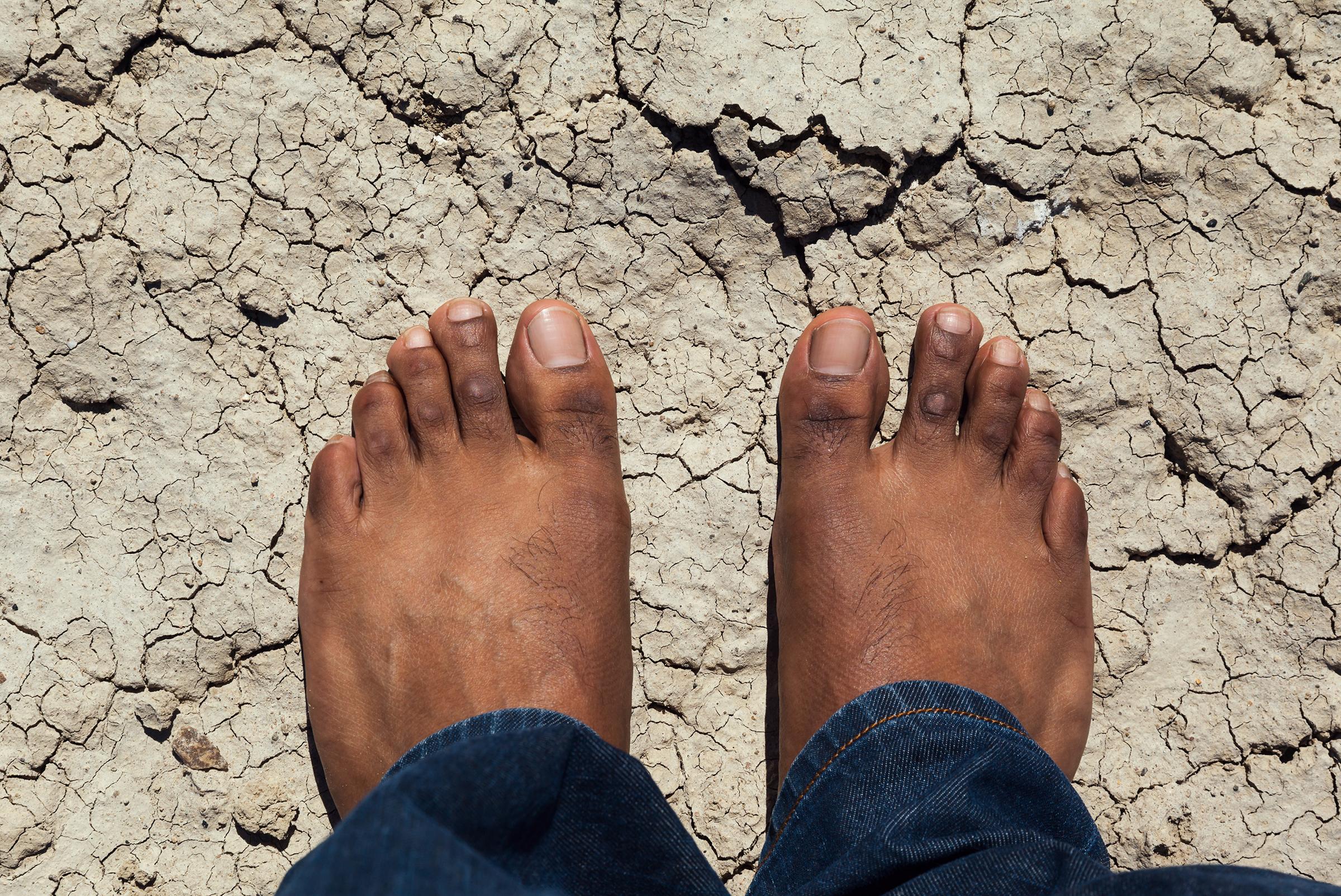 Treating Cracked Heels 