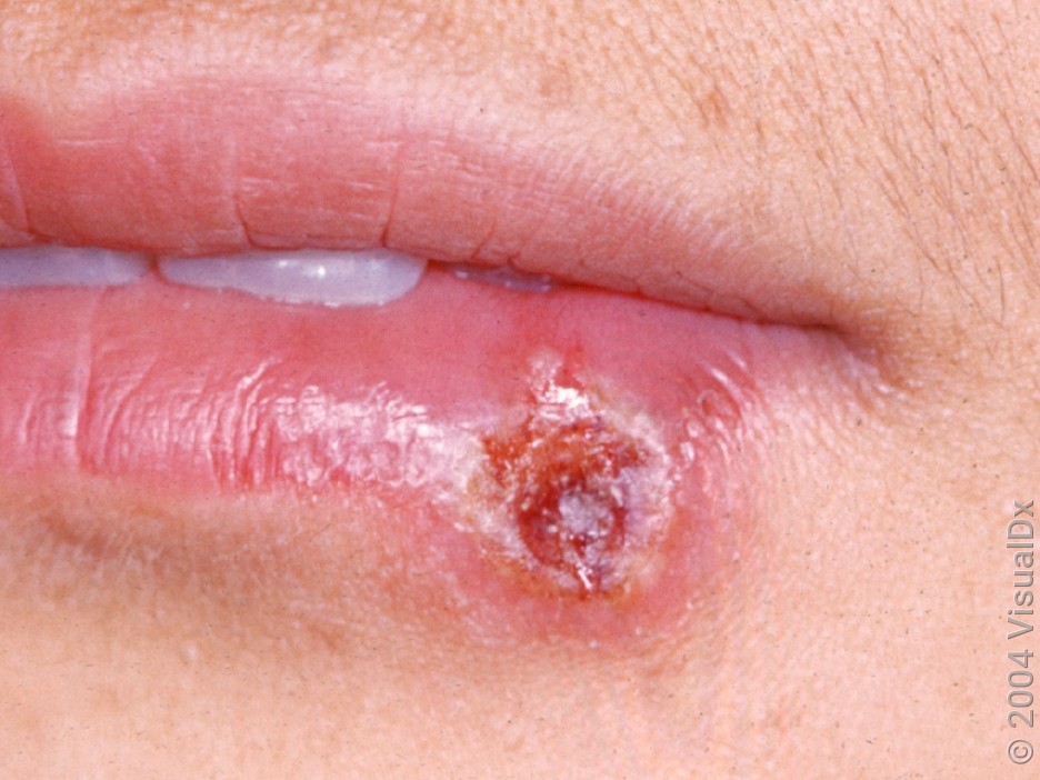 Close-up of a crusted herpes sore.