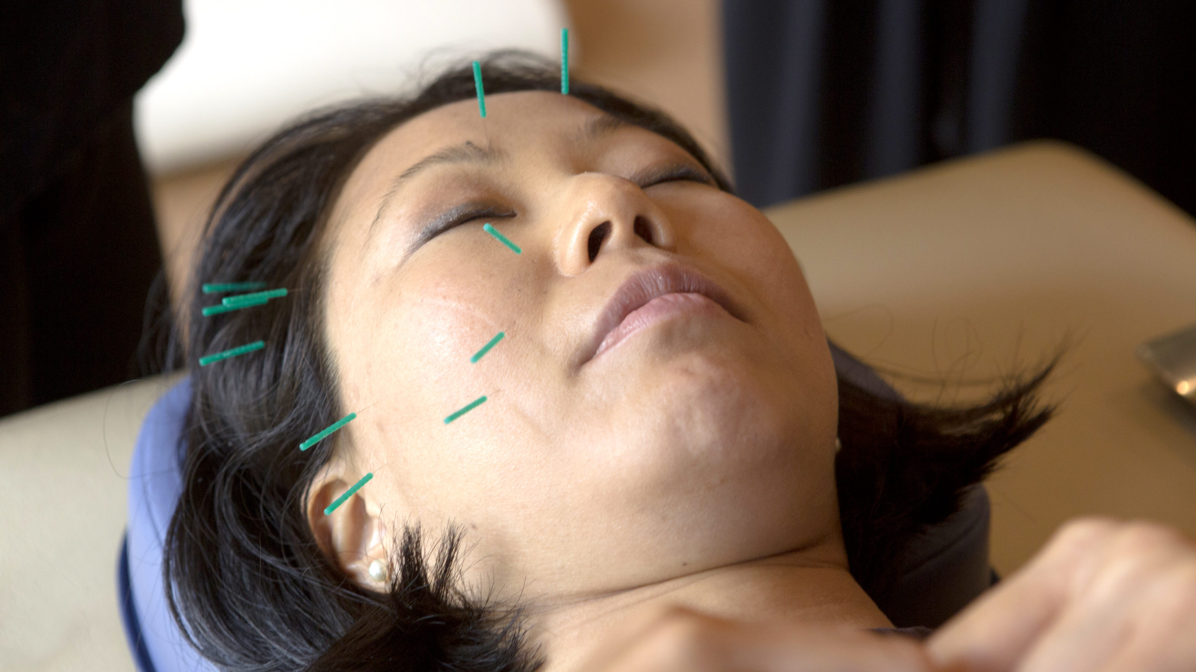 How Much Does Acupuncture Cost? Insurance Coverage and Price ...