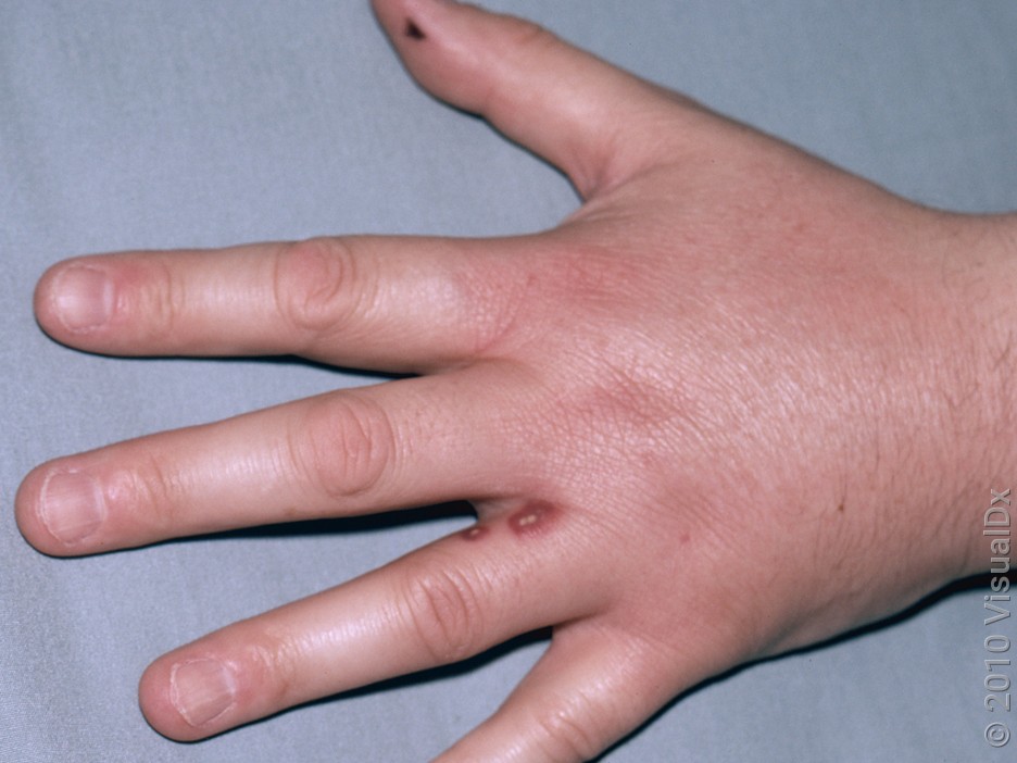 Close-up of a hand with two blisters surrounded by swelling and redness from a spider bite. 