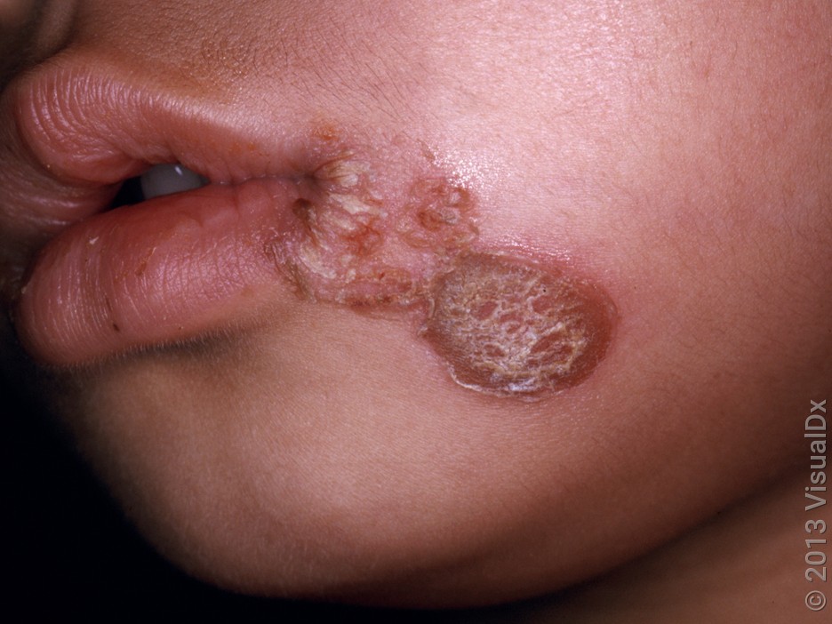 Close-up of a child’s face with round, reddish, crusty patches near the mouth in impetigo. 