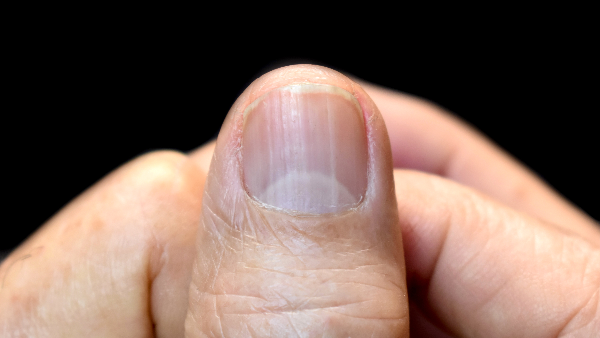 Close-up thumbnail showing vertical ridges and visible lunula indicating nail texture changes