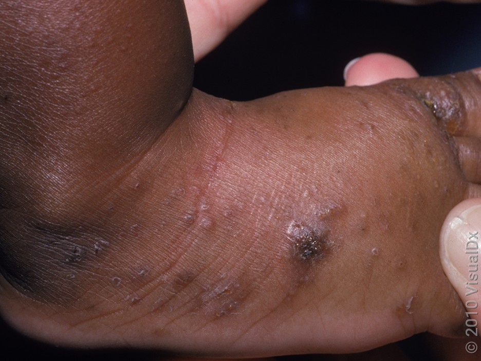 Close-up of an infant’s foot with clusters of pink, brown, and crusty bumps in scabies. 