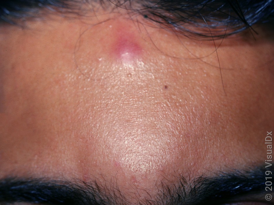 Close-up of a forehead with a smooth, pink bump from a spider bite. 