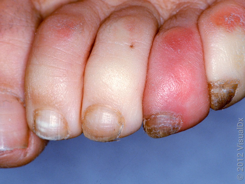 Close-up of Raynaud’s syndrome on the feet. 