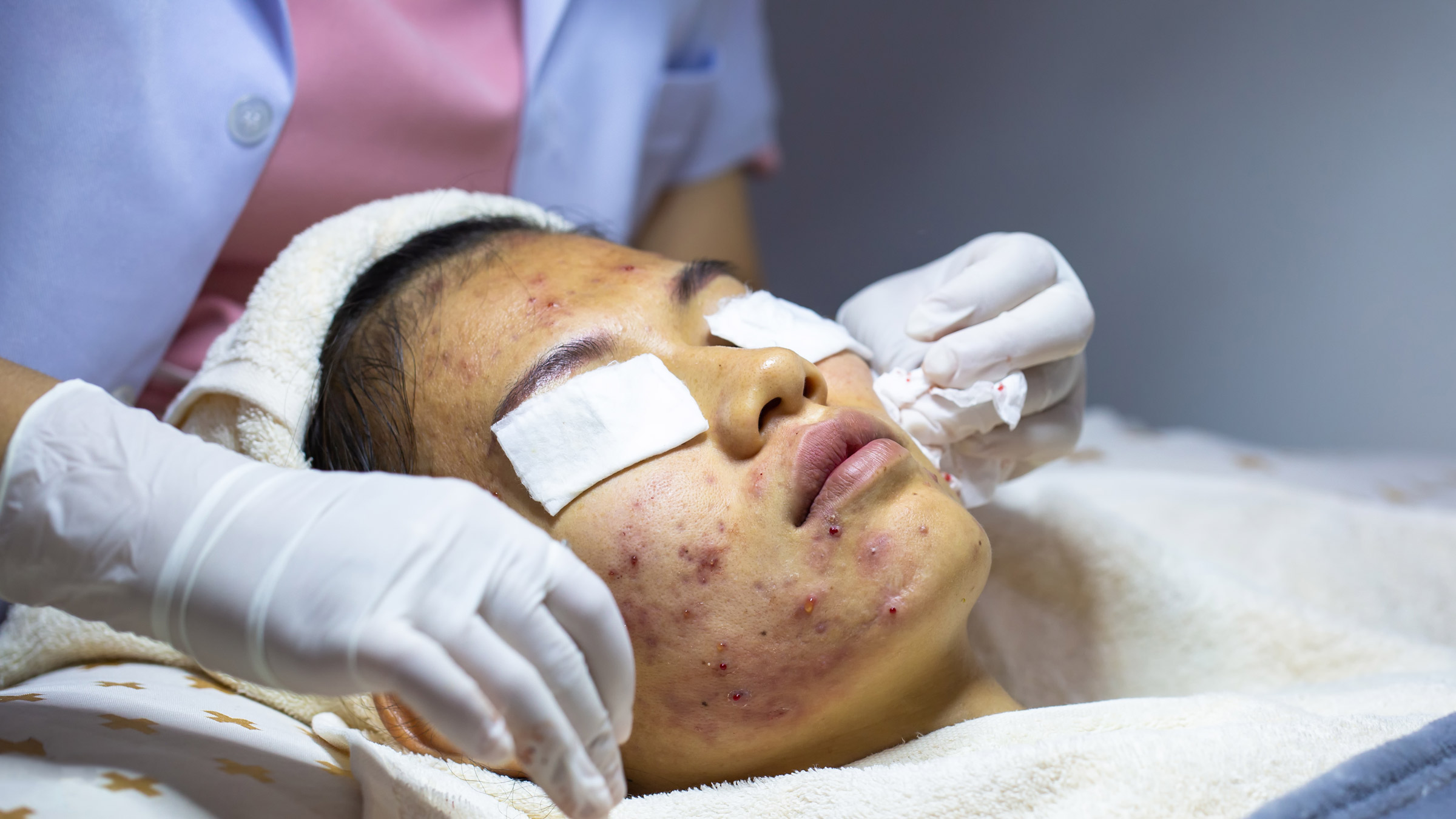 A person with severe acne getting a treatment from a dermatologist. 
Tinnakorn Jorruang/iStock via Getty Images Plus  