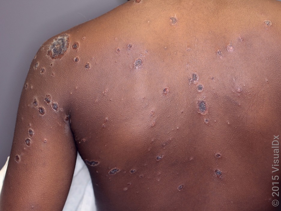 A child’s back and arm with many round, crusty sores in impetigo. 