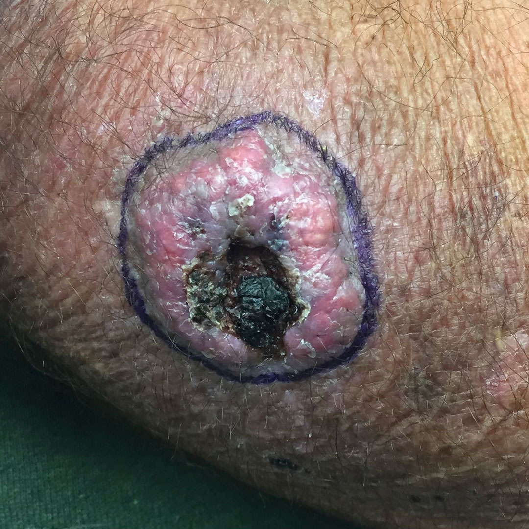 symptoms of skin cancer on leg