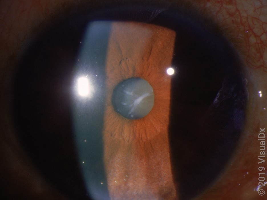 Undilated pupil with cataract, as seen during an eye exam.