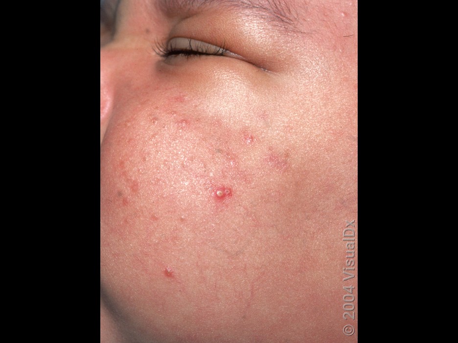 An infant’s cheek with a few red and white bumps in infantile acne.