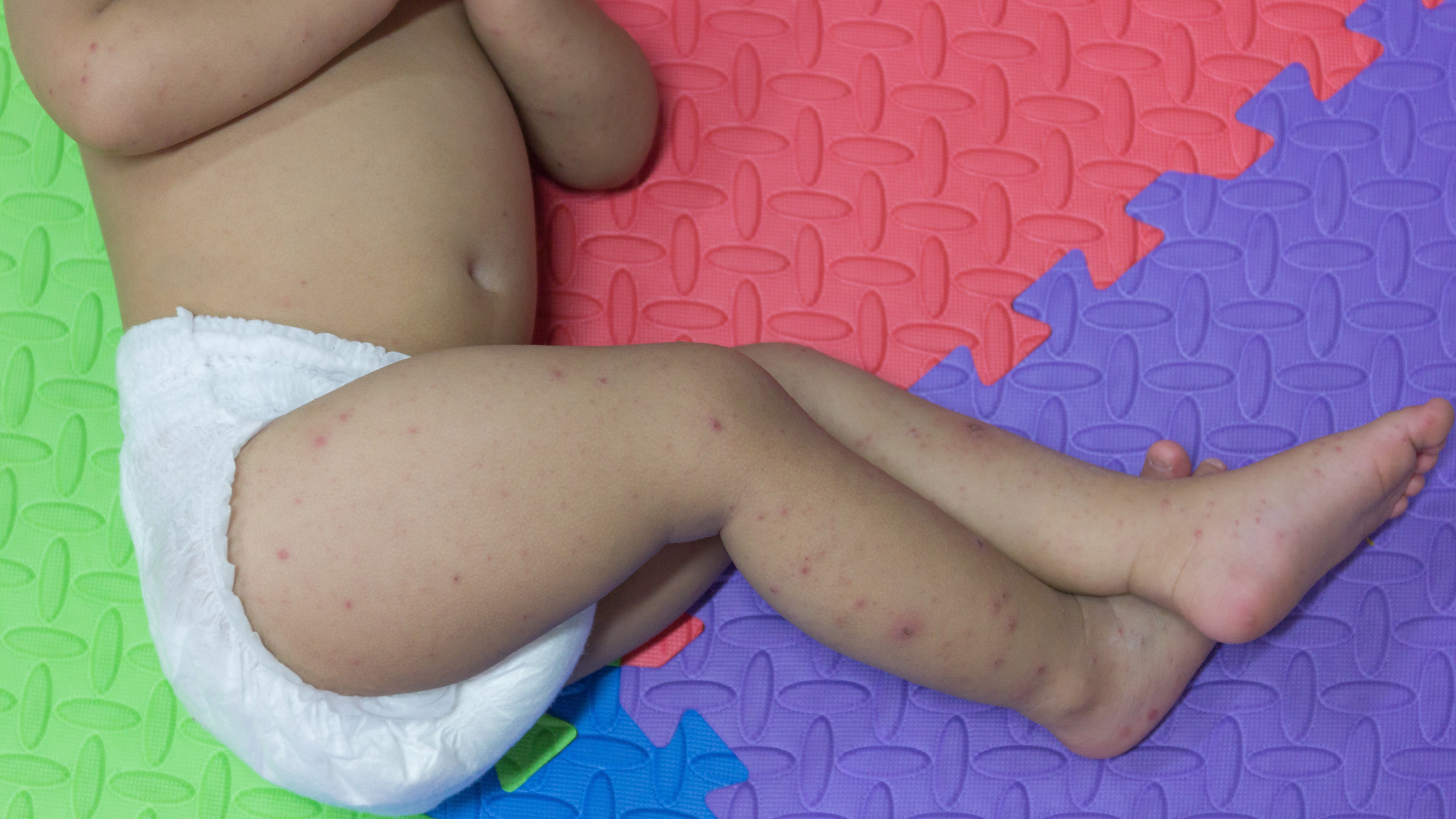 What Is Hand, Foot, and Mouth Disease (HFMD)? What Is Hand, Foot, and Mouth  Disease (HFMD)? - GoodRx