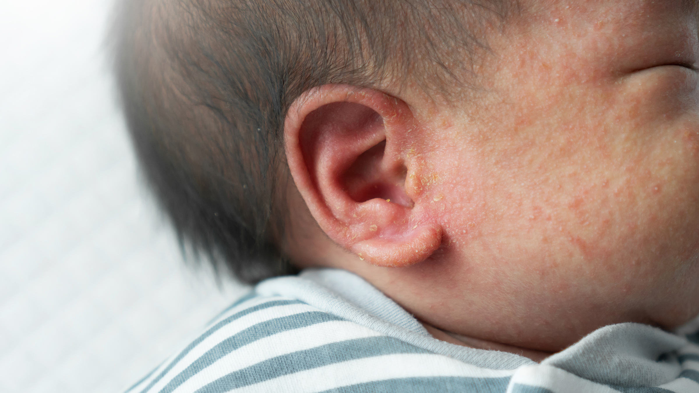 Do some sort of water in ear have trapped? This problem may arise while you  are swimming in a river or pond an… | Water in ear, Excessive ear wax, Dry  skin