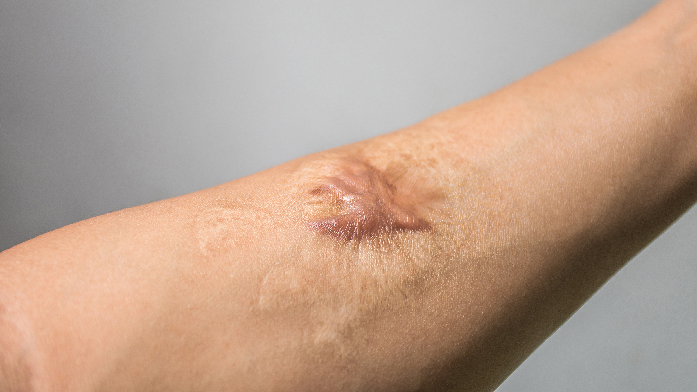 The Average Cost of Laser Scar Removal - GoodRx