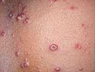 Chickenpox Or Hand Foot And Mouth Disease Differences And Images 