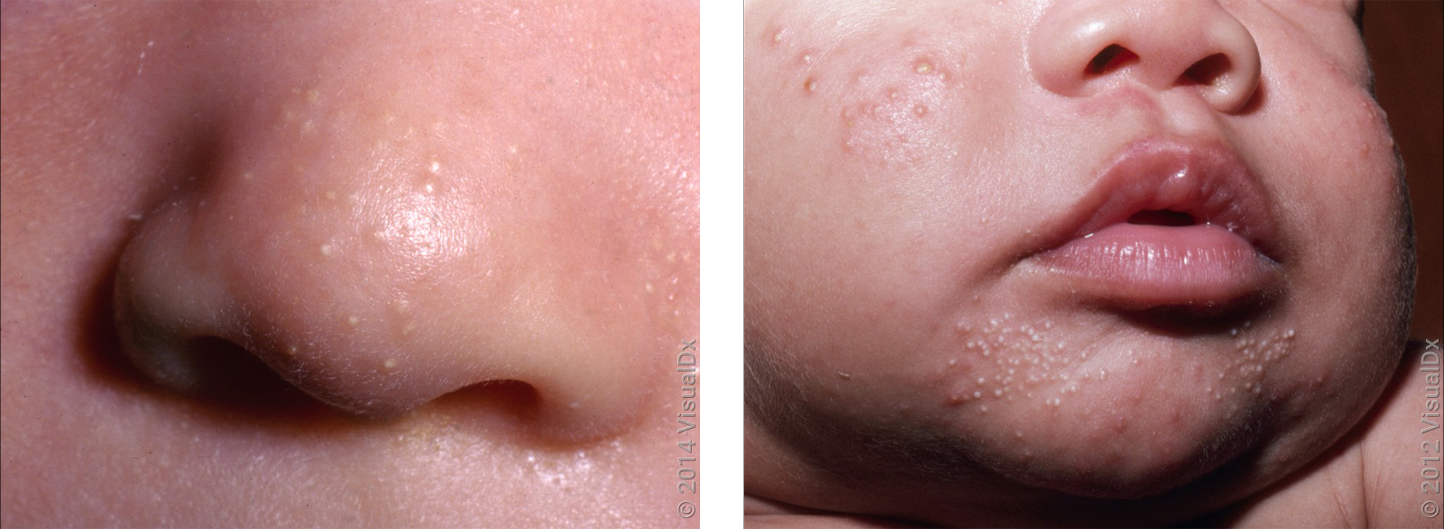Left: Close-up of an infant's nose with many tiny, smooth white and yellow bumps. Right: Many small, white bumps on the chin and cheek in an infant with both milia and baby acne.