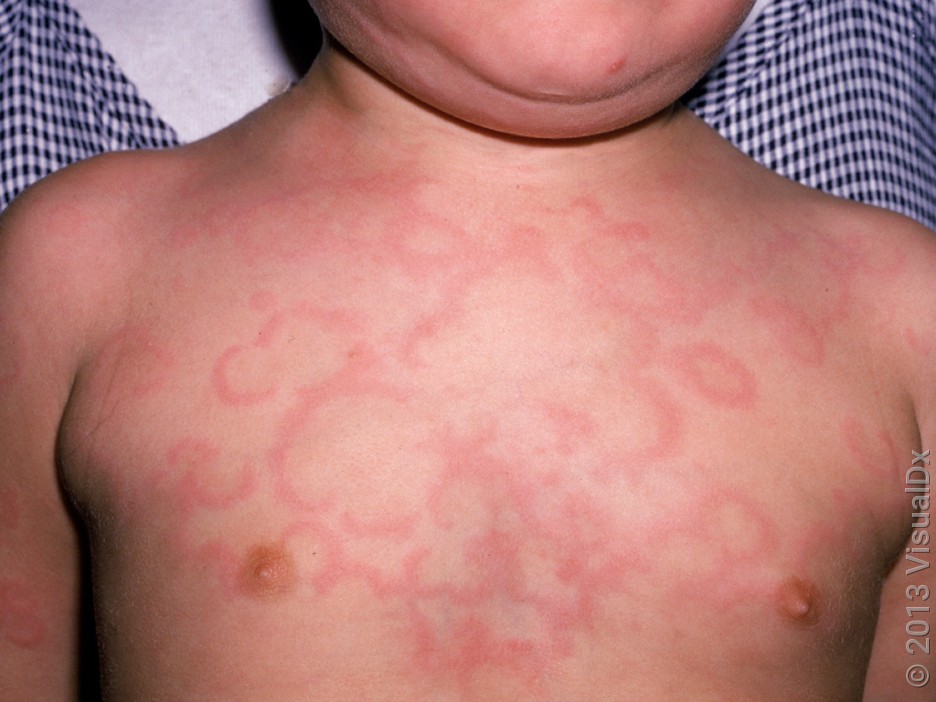 Many ring-shaped red patches on the chest caused by hives. 