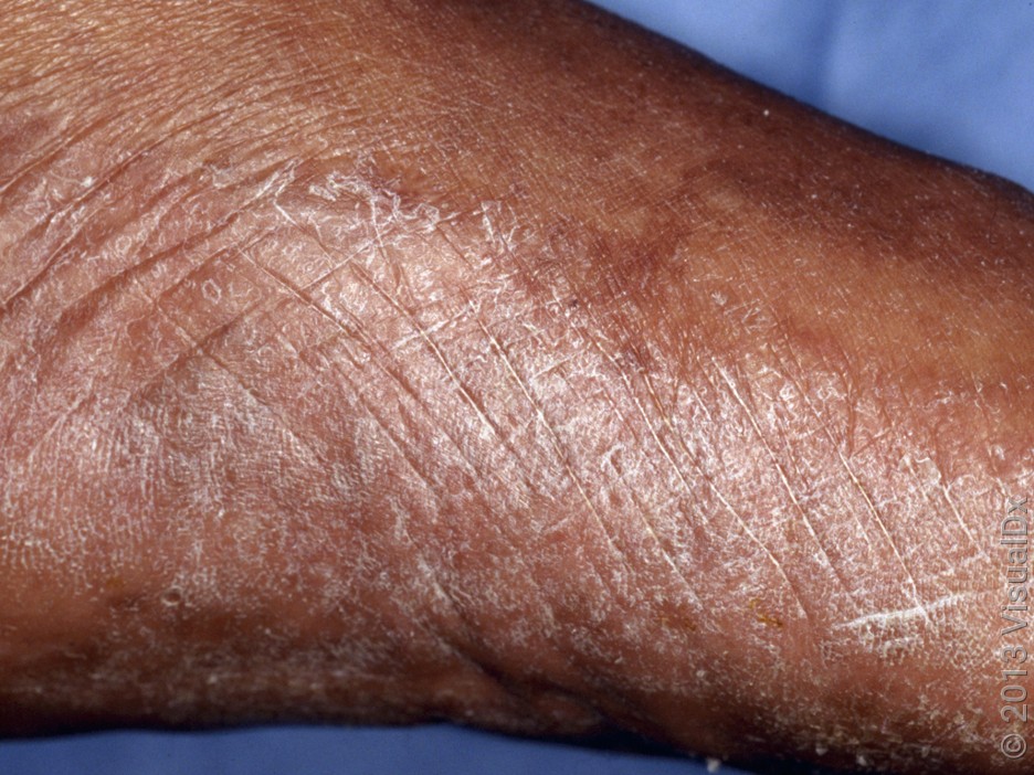 Minor athlete’s foot causes a scaly rash on the sides and bottom of the foot. 